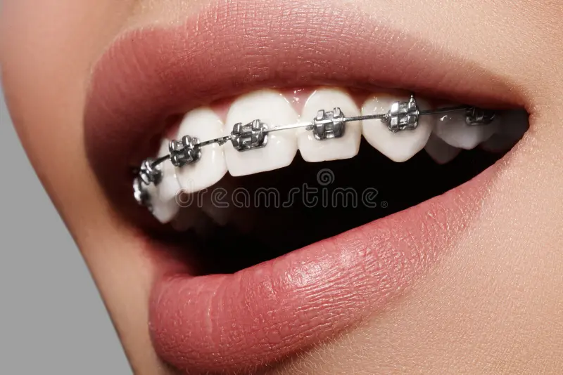 Quality Braces